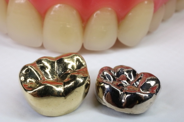銀歯イメージ画像　もりもと歯科｜銀歯の方は要注意　水銀を含む「アマルガム」とは